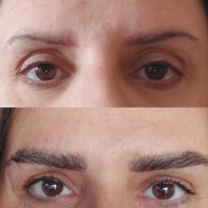 FUE BROWS WOMAN